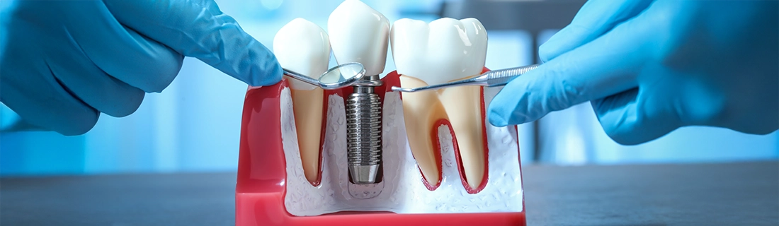 How Long Do Dental Implants In Wall Township NJ Last: Lifespan Factors and Tips How Long Do Dental Implants In Wall Township NJ Last: Lifespan Factors and Tips