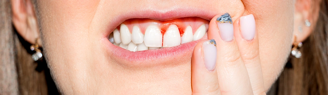Why Your Gums Might Be Bleeding In Wall Township NJ & What You Should Do About It Why Your Gums Might Be Bleeding In Wall Township NJ & What You Should Do About It