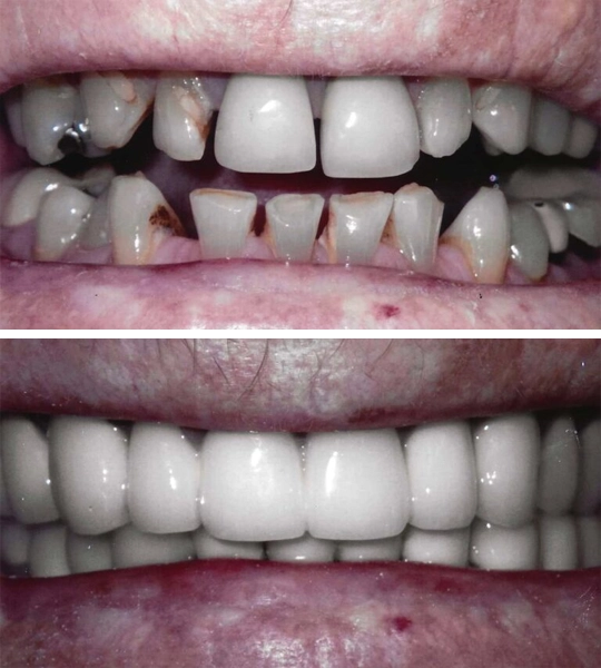 Before And After Of A Reconstructed Smile